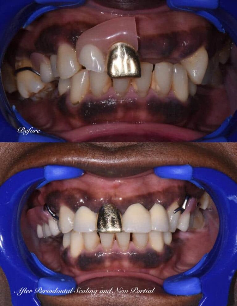 Scaling and Root Planing | Dental Solutions | Canton, MS 39046