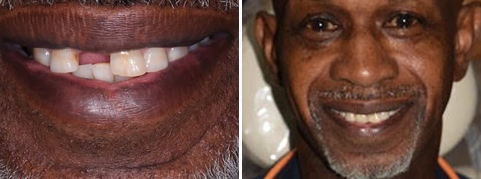 Before and after dental treatment Dental Solutions of Mississippi dentist in Canton MS Dr. Ruth Roach Morgan Dr. Jessica Morgan