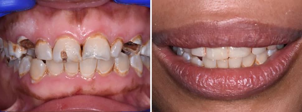 Before and after dental treatment Dental Solutions of Mississippi dentist in Canton MS Dr. Ruth Roach Morgan Dr. Jessica Morgan