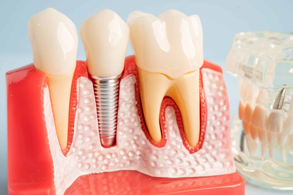 Dental Implants Canton